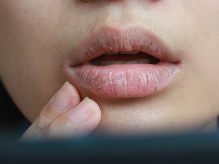 dry mouth